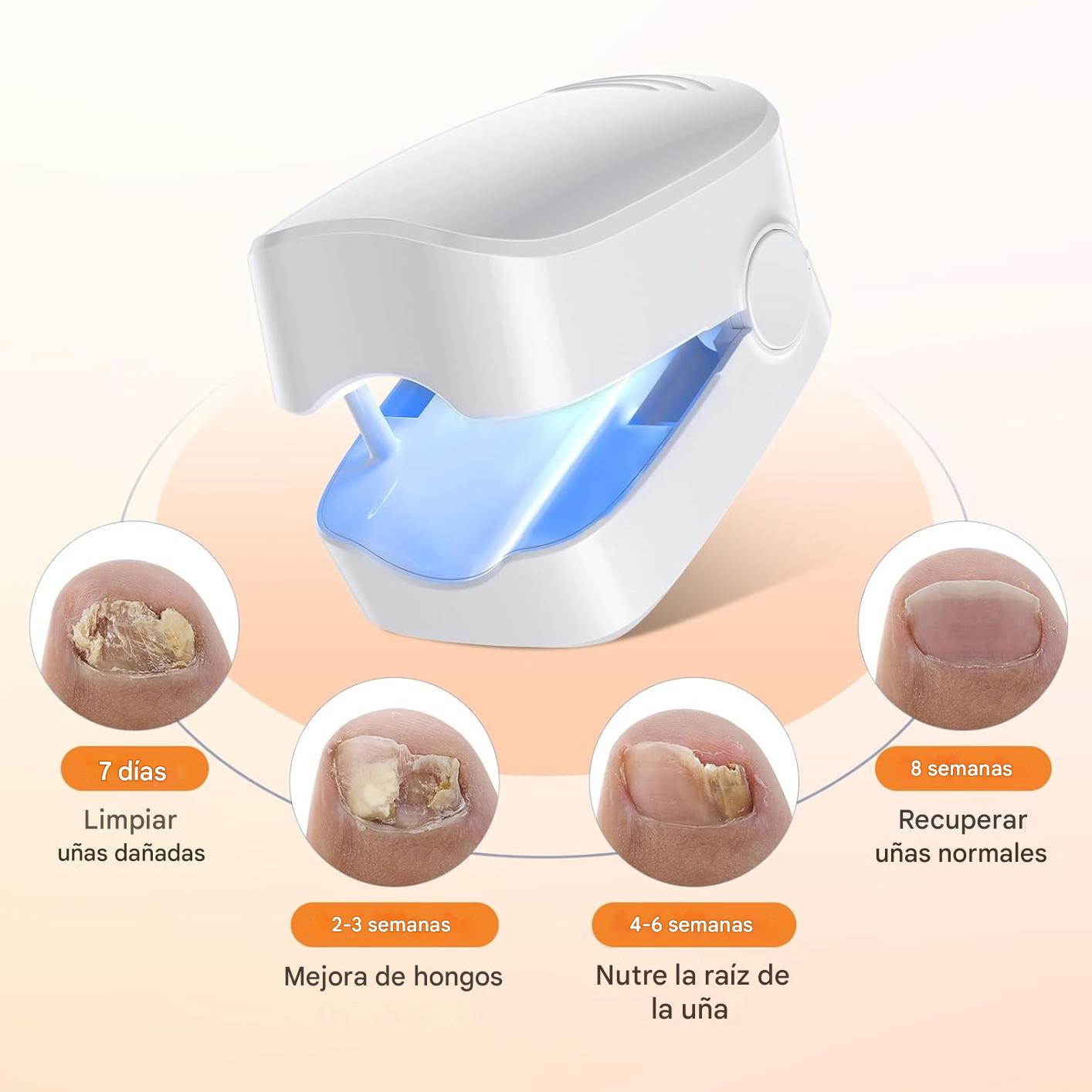Dispositivo láser antimicótico para la eliminación de hongos en las uñas.